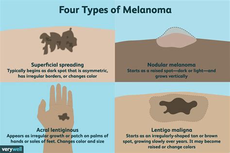 4 types of malignant melanoma